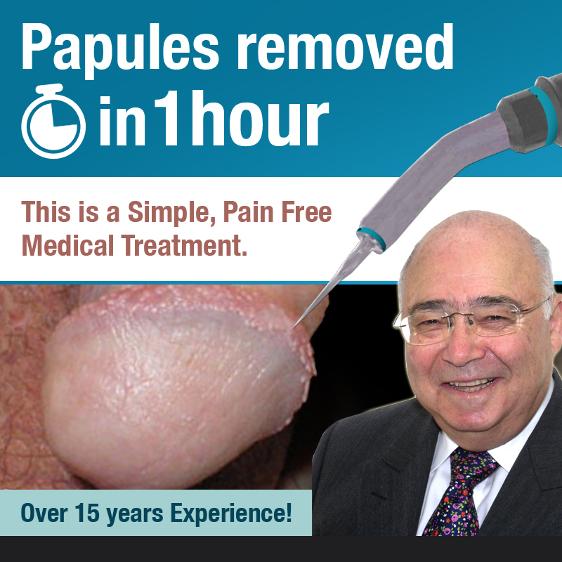 Pearly Penile Papules removal being performed